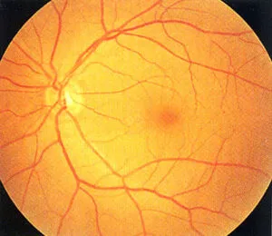 正常な網膜