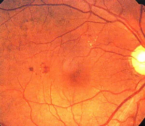 初期の網膜症
