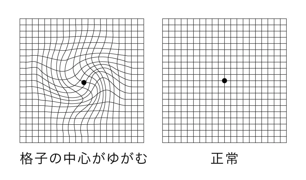 黄斑変性症の症状